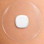 Medtronic Simplera Sync sensor beneath a 3.15-inch clear overpatch on skin