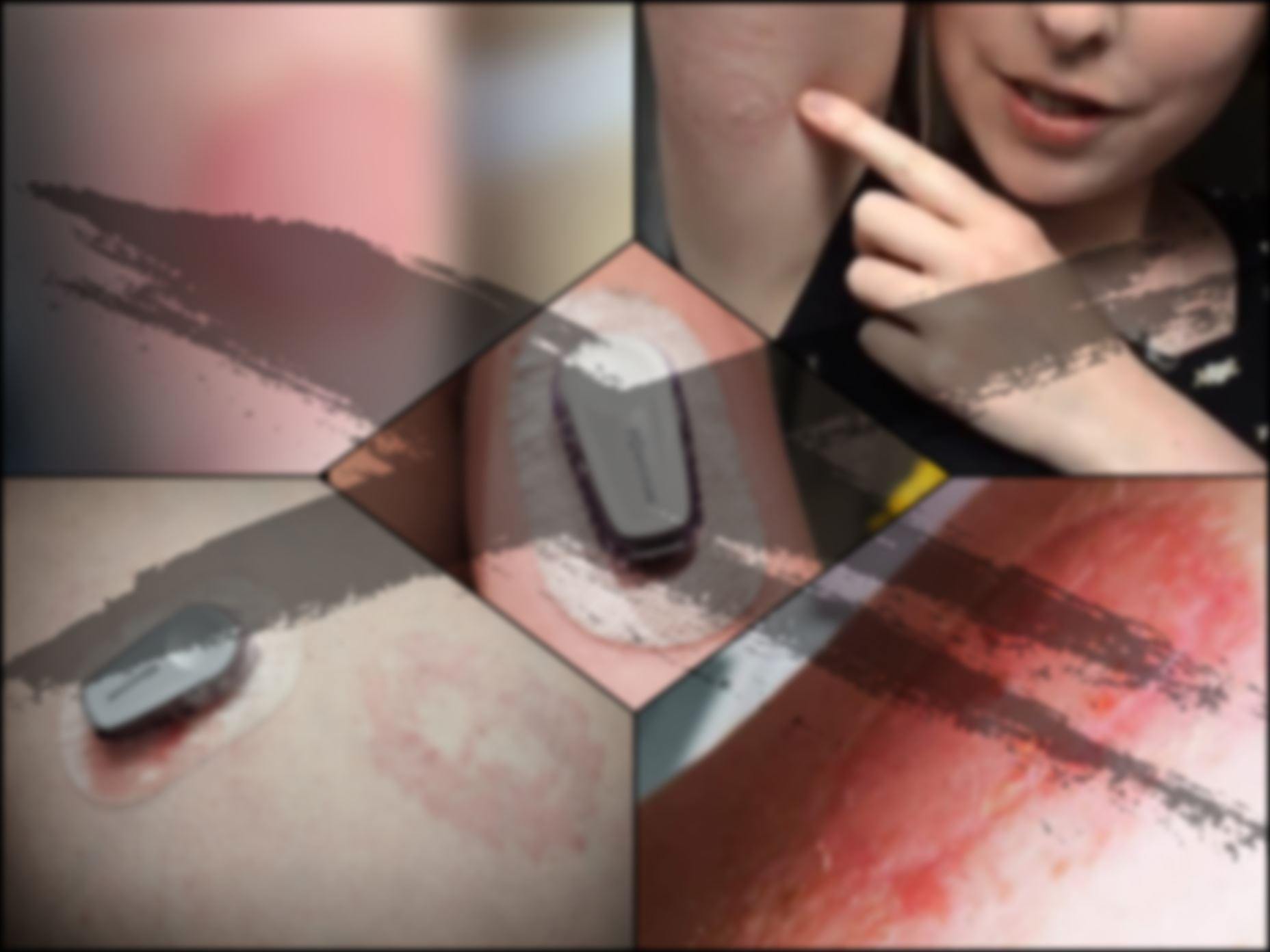 Dexcom G6 : Allergy Underlay Skin Barrier Adhesive Patches - adhesive allergy, adhesive patch, adhesive sticker, allergic, barrier, decom g6 allergy barrier, Dexcom, Dexcom G6, Dexcom protection, freedom band, protective patch, underlay, waterproof patch